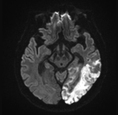 뇌경색(화살표로 표시) MRI