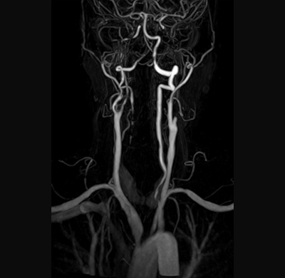경동맥 폐색증 MRA